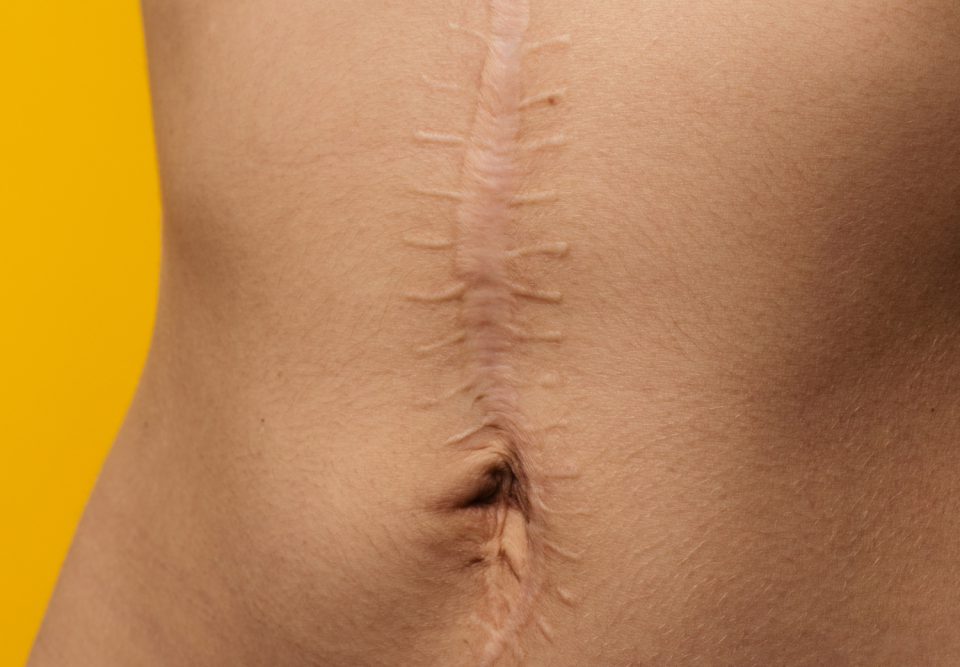 Scars Removal Concept, Large Scar After Surgery On The Abdomen Young Woman,